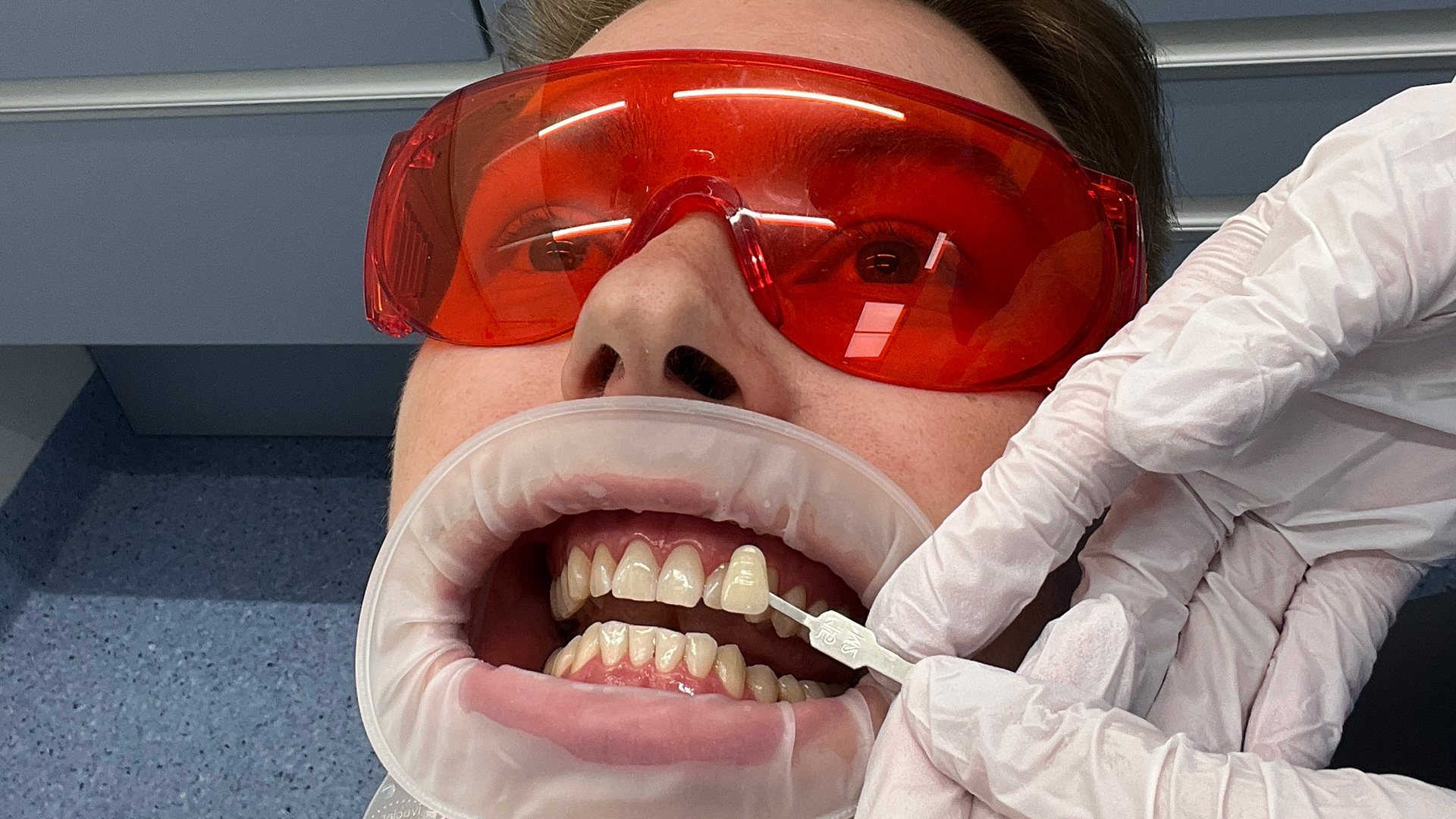 Kuva hampaista hammaskiven poiston ja pikavalkaisun jälkeen.